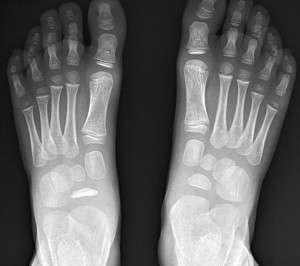 The treatment of this condition is the use of a cast or splint with a ...